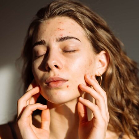 Does Sun Exposure Really Help Acne?